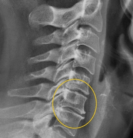 zervikale Osteochondrose